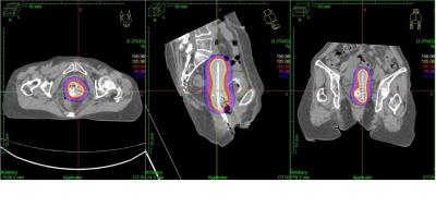 Brakhiterapi Perencanaan Dosis Radiasi